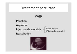 Traitement	percutané	
PAIR	
PoncKon		
AspiraKon	
InjecKon	de	scolicide	
ReaspiraKon	
	
	
	
	
Alcool	absolu	
1/3	du	volume	aspiré	
 