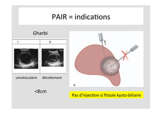 PAIR	=	indicaKons	
	
	
	
	
Gharbi		
univésiculaire	 décollement	
<8cm		
Pas	d’injecKon	si	ﬁstule	kysto-biliaire	
 