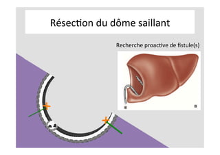 RésecKon	du	dôme	saillant	
Recherche	proacKve	de	ﬁstule(s)	
	
	
 