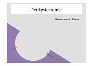 Périkystectomie	
Hémostase	et	bilistase	
	
	
 