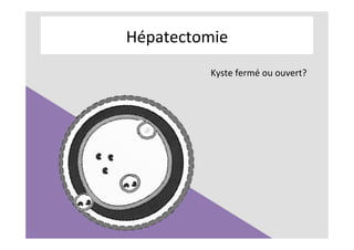 Hépatectomie	
Kyste	fermé	ou	ouvert?	
 