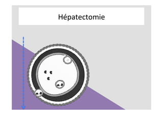Hépatectomie	
 