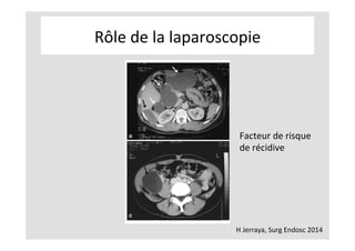 Rôle	de	la	laparoscopie	
H	Jerraya,	Surg	Endosc	2014	
Facteur	de	risque	
de	récidive	
 