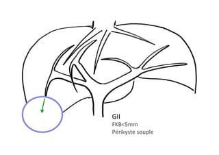 GII	
FKB<5mm	
Périkyste	souple	
 