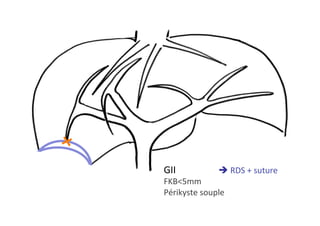 GII 	 	è	RDS	+	suture	
FKB<5mm	
Périkyste	souple	
 