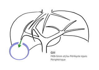 GIII	
FKB>5mm	et/ou	Périkyste	épais	
Périphérique	
 