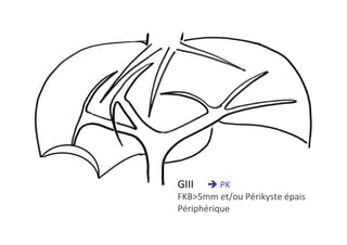 GIII 	è	PK	
FKB>5mm	et/ou	Périkyste	épais	
Périphérique	
 