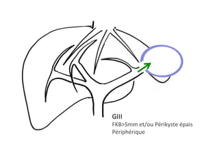GIII 		
FKB>5mm	et/ou	Périkyste	épais	
Périphérique	
 