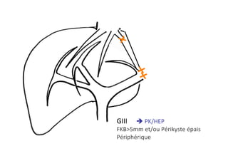 GIII 	è	PK/HEP	
FKB>5mm	et/ou	Périkyste	épais	
Périphérique	
 