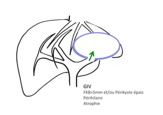 GIV 		
FKB>5mm	et/ou	Périkyste	épais	
Périhilaire	
Atrophie		
 