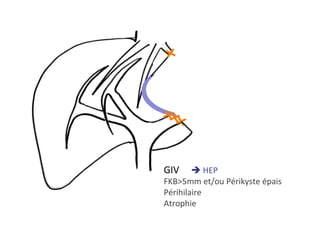 GIV 	è	HEP	
FKB>5mm	et/ou	Périkyste	épais	
Périhilaire	
Atrophie		
 