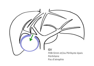 GV 		
FKB>5mm	et/ou	Périkyste	épais	
Périhilaire	
Pas	d’atrophie		
 