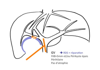 GV 	è	RDS	+	réparaKon	
FKB>5mm	et/ou	Périkyste	épais	
Périhilaire	
Pas	d’atrophie		
 