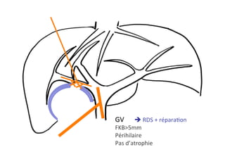 GV 	è	RDS	+	réparaKon	
FKB>5mm	
Périhilaire	
Pas	d’atrophie		
 