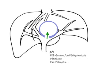 GV 		
FKB>5mm	et/ou	Périkyste	épais	
Périhilaire	
Pas	d’atrophie		
 
