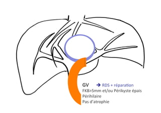 GV 	è	RDS	+	réparaKon	
FKB>5mm	et/ou	Périkyste	épais	
Périhilaire	
Pas	d’atrophie		
	
 