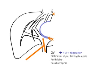 GV 	è	HEP	+	réparaKon	
FKB>5mm	et/ou	Périkyste	épais	
Périhilaire	
Pas	d’atrophie		
 