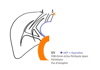 GV 	è	HEP	+	réparaKon	
FKB>5mm	et/ou	Périkyste	épais	
Périhilaire	
Pas	d’atrophie		
 