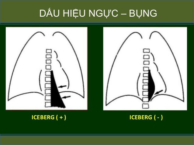 Image result for dáº¥u hiá»u ngá»±c bá»¥ng