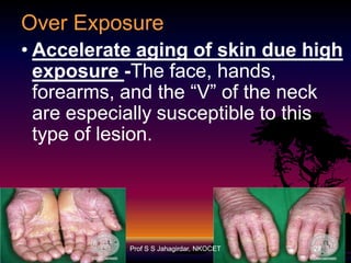 Over Exposure
• Accelerate aging of skin due high
exposure -The face, hands,
forearms, and the “V” of the neck
are especially susceptible to this
type of lesion.

Prof S S Jahagirdar, NKOCET

28

 