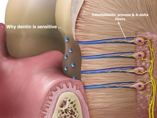 Odontoblastic process & A-delta
fibers
- Why dentin is sensitive ..
 