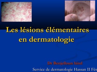 Les lésions élémentaires
   en dermatologie

                Dr Benjelloun hind
       Service de dermatologie Hassan II Fès
 