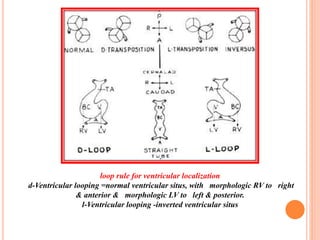 loop rule for ventricular localization
d-Ventricular looping =normal ventricular situs, with morphologic RV to right
& anterior & morphologic LV to left & posterior.
l-Ventricular looping -inverted ventricular situs
 