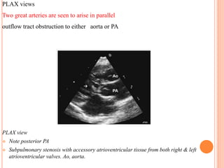 PLAX view
 Note posterior PA
 Subpulmonary stenosis with accessory atrioventricular tissue from both right & left
atrioventricular valves. Ao, aorta.
PLAX views
Two great arteries are seen to arise in parallel
outflow tract obstruction to either aorta or PA
 