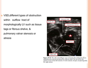  VSD,different types of obstruction
within outflow tract of
morphologically LV such as tissue
tags or fibrous shelve, &
pulmonary valvar stenosis or
atresia
 