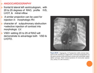  ANGIOCARDIOGRAPHY
 frontal & lateral left ventriculogram, with
20 to 25 degrees of RAO, profile IVS,
LVOT, & mitral inflow
 A similar projection can be used for
injection in morphologic RV.
 character of subpulmonary obstruction
=selective injection of contrast into
morphologic LV.
 VSD= adding 20 to 25 of RAO will
demonstrate to advantage both VSD &
LVOTO.
 