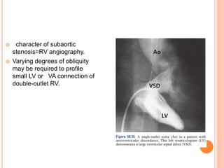  character of subaortic
stenosis=RV angiography.
 Varying degrees of obliquity
may be required to profile
small LV or VA connection of
double-outlet RV.
 