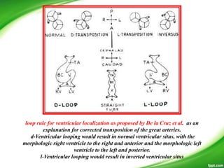 loop rule for ventricular localization as proposed by De la Cruz et al. as an
explanation for corrected transposition of the great arteries.
d-Ventricular looping would result in normal ventricular situs, with the
morphologic right ventricle to the right and anterior and the morphologic left
ventricle to the left and posterior.
l-Ventricular looping would result in inverted ventricular situs
 