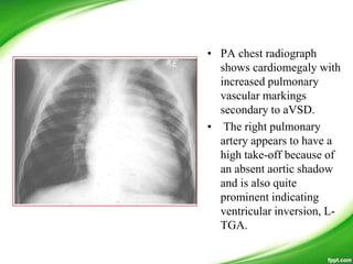 • PA chest radiograph
shows cardiomegaly with
increased pulmonary
vascular markings
secondary to aVSD.
• The right pulmonary
artery appears to have a
high take-off because of
an absent aortic shadow
and is also quite
prominent indicating
ventricular inversion, L-
TGA.
 
