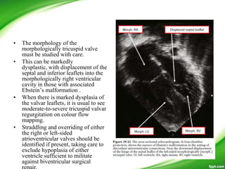 • The morphology of the
morphologically tricuspid valve
must be studied with care.
• This can be markedly
dysplastic, with displacement of the
septal and inferior leaflets into the
morphologically right ventricular
cavity in those with associated
Ebstein’s malformation .
• When there is marked dysplasia of
the valvar leaflets, it is usual to see
moderate-to-severe tricuspid valvar
regurgitation on colour flow
mapping.
• Straddling and overriding of either
the right or left-sided
atrioventricular valves should be
identified if present, taking care to
exclude hypoplasia of either
ventricle sufficient to militate
against biventricular surgical
 
