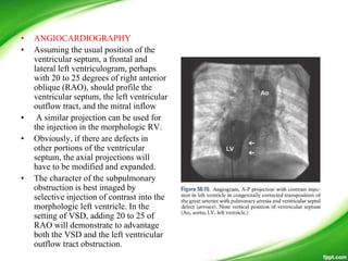 • ANGIOCARDIOGRAPHY
• Assuming the usual position of the
ventricular septum, a frontal and
lateral left ventriculogram, perhaps
with 20 to 25 degrees of right anterior
oblique (RAO), should profile the
ventricular septum, the left ventricular
outflow tract, and the mitral inflow
• A similar projection can be used for
the injection in the morphologic RV.
• Obviously, if there are defects in
other portions of the ventricular
septum, the axial projections will
have to be modified and expanded.
• The character of the subpulmonary
obstruction is best imaged by
selective injection of contrast into the
morphologic left ventricle. In the
setting of VSD, adding 20 to 25 of
RAO will demonstrate to advantage
both the VSD and the left ventricular
outflow tract obstruction.
 