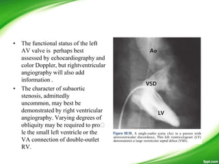 • The functional status of the left
AV valve is perhaps best
assessed by echocardiography and
color Doppler, but rightventricular
angiography will also add
information .
• The character of subaortic
stenosis, admittedly
uncommon, may best be
demonstrated by right ventricular
angiography. Varying degrees of
obliquity may be required to pro
le the small left ventricle or the
VA connection of double-outlet
RV.
 