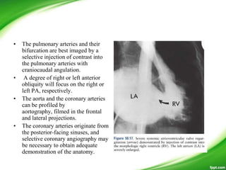 • The pulmonary arteries and their
bifurcation are best imaged by a
selective injection of contrast into
the pulmonary arteries with
craniocaudal angulation.
• A degree of right or left anterior
obliquity will focus on the right or
left PA, respectively.
• The aorta and the coronary arteries
can be profiled by
aortography, filmed in the frontal
and lateral projections.
• The coronary arteries originate from
the posterior-facing sinuses, and
selective coronary angiography may
be necessary to obtain adequate
demonstration of the anatomy.
 