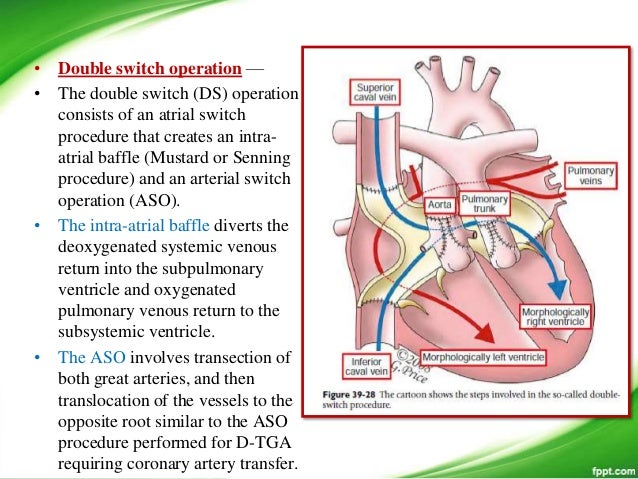 â€¢ Ventricular Rerouting Combined
with Atrial Redirection
â€¢ The atrial switch is performed in the
same manor as for the dou...