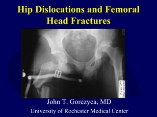 Hip Dislocations and Femoral
Head Fractures
John T. Gorczyca, MD
University of Rochester Medical Center
 