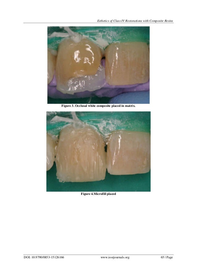 Esthetics of Class IV Restorations with Composite Resins