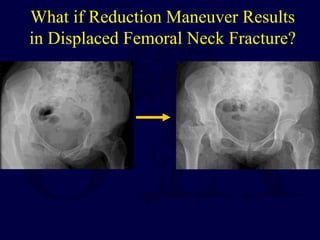 What if Reduction Maneuver Results
in Displaced Femoral Neck Fracture?
 