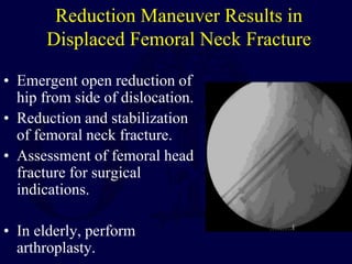 Reduction Maneuver Results in
Displaced Femoral Neck Fracture
• Emergent open reduction of
hip from side of dislocation.
• Reduction and stabilization
of femoral neck fracture.
• Assessment of femoral head
fracture for surgical
indications.
• In elderly, perform
arthroplasty.
 