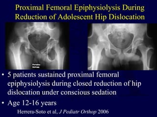 Proximal Femoral Epiphysiolysis During
Reduction of Adolescent Hip Dislocation
• 5 patients sustained proximal femoral
epiphysiolysis during closed reduction of hip
dislocation under conscious sedation
• Age 12-16 years
Herrera-Soto et al, J Pediatr Orthop 2006
 