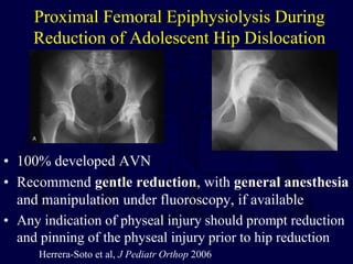 Proximal Femoral Epiphysiolysis During
Reduction of Adolescent Hip Dislocation
• 100% developed AVN
• Recommend gentle reduction, with general anesthesia
and manipulation under fluoroscopy, if available
• Any indication of physeal injury should prompt reduction
and pinning of the physeal injury prior to hip reduction
Herrera-Soto et al, J Pediatr Orthop 2006
 