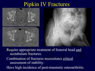 Pipkin IV Fractures
Require appropriate treatment of femoral head and
acetabulum fractures.
Combination of fractures necessitates critical
assessment of stability.
Have high incidence of post-traumatic osteoarthritis.
 