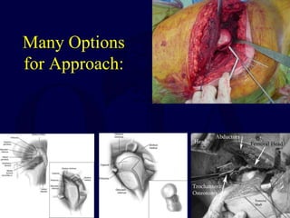 Many Options
for Approach:
 