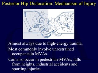 Posterior Hip Dislocation: Mechanism of Injury
Almost always due to high-energy trauma.
Most commonly involve unrestrained
occupants in MVAs.
Can also occur in pedestrian-MVAs, falls
from heights, industrial accidents and
sporting injuries.
 