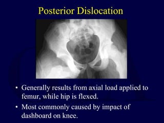 Posterior Dislocation
• Generally results from axial load applied to
femur, while hip is flexed.
• Most commonly caused by impact of
dashboard on knee.
 