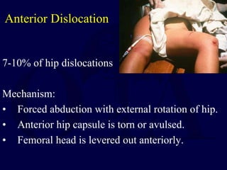 Anterior Dislocation
7-10% of hip dislocations
Mechanism:
• Forced abduction with external rotation of hip.
• Anterior hip capsule is torn or avulsed.
• Femoral head is levered out anteriorly.
 