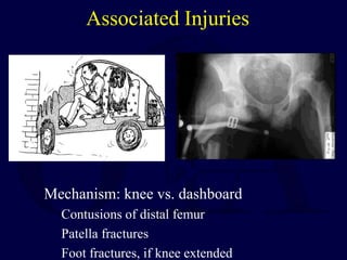 Associated Injuries
Mechanism: knee vs. dashboard
Contusions of distal femur
Patella fractures
Foot fractures, if knee extended
 